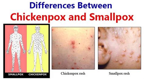 Difference Between Smallpox And Chickenpox