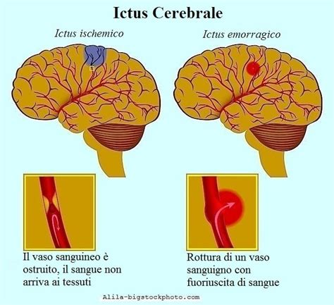 differenza tra emorragia cerebrale e ictus