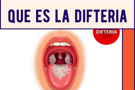 Difteria Que Es