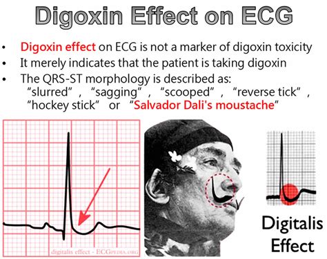 Digoxin Toxicity Ecg