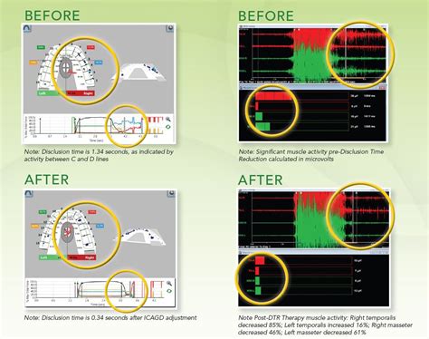 Disclusion Time Reduction