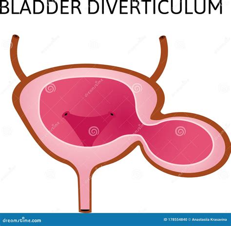 Diverticula On Bladder