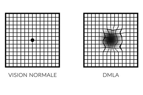 dmla da c ga c na c rescence maculaire lia c e a