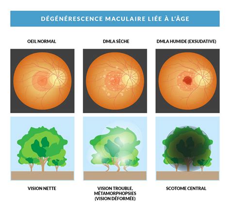 Dmla La Da C Ga C Na C Rescence Maculaire Lia C E