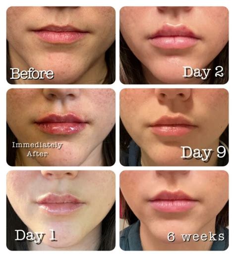 do lip injection swelling go down every morning