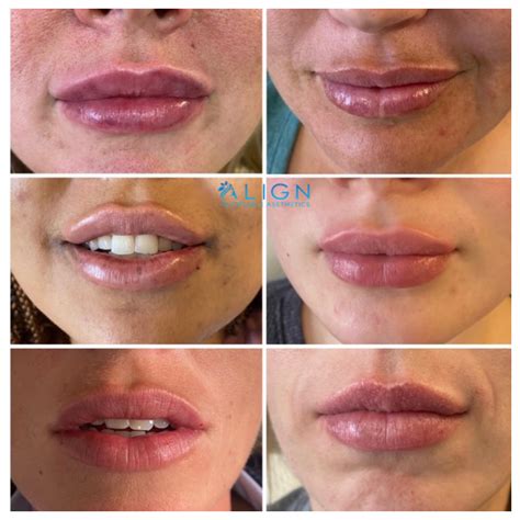 do lip injection swelling go down every year