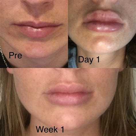 do lip injection swelling go down lower back