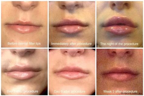 do lip injection swelling go down lower eyelid