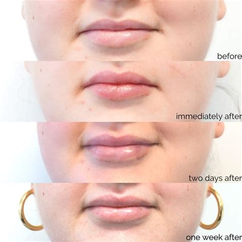 do lip injection swelling go down lower