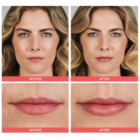 do lips get bigger after filler