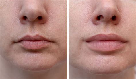 do lips return to normal after fillers surgery