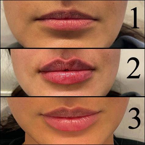 do lips swell day after filler