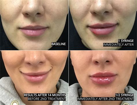 do lips swell immediately after filler treatment