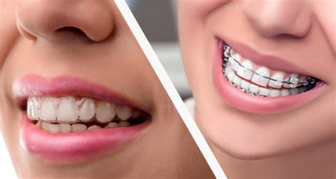 do you need braces after invisalign
