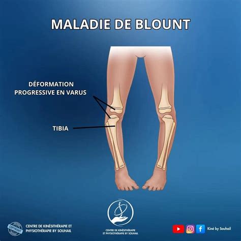 Doença De Blount