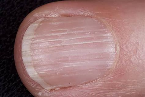 Doenças Em Unhas
