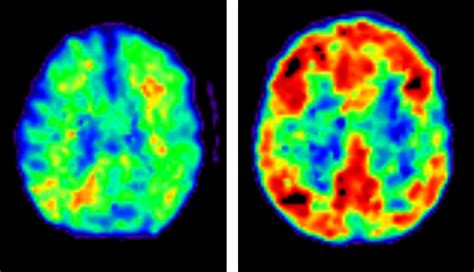 does a brain scan show dementia