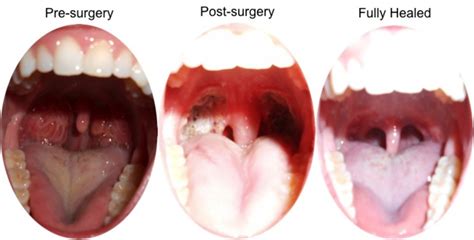 does anyone pick their tonsils? SkinPick.com