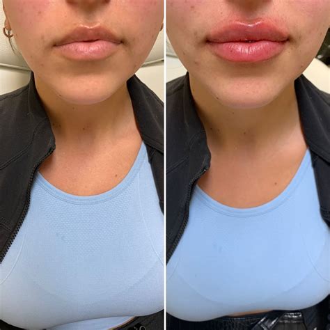 does kissing affect lip fillers before and after