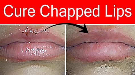 does kissing help chapped lips heal quickly