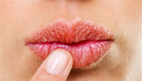 does kissing help chapped lips itch symptoms