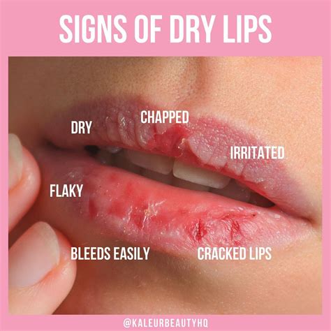 does kissing help dry lips