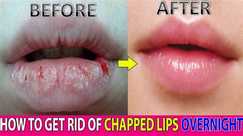 does kissing make your lips chapped how cchapped title=