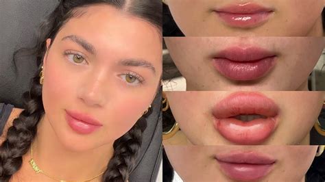 does kissing ruin lip fillers really