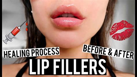 does kissing ruin lip fillers really