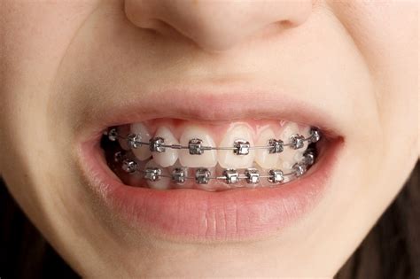 does kissing someone with braces cause pain images