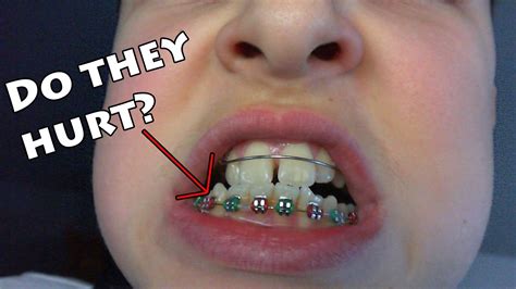 does kissing with braces hurt teeth causes