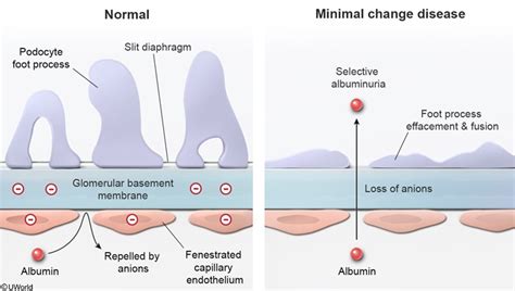 Does Minimal Change Disease Effacement