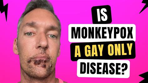 does monkeypox only affect gay people