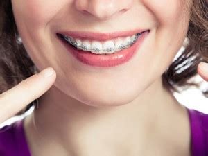 does wearing braces affect kissing women