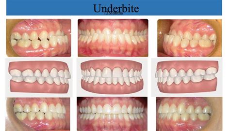 does wearing braces affect kissing