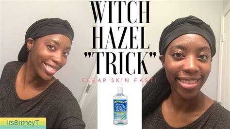 does witch hazel fade dark spots