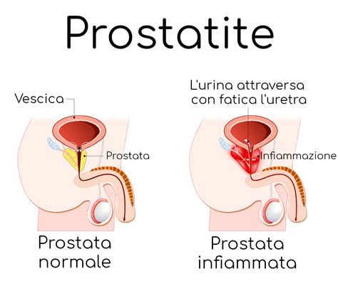 dolore pelvico prostatite