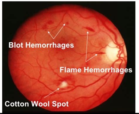 Dot Blot Hemorrhages