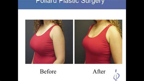 double d breast lift