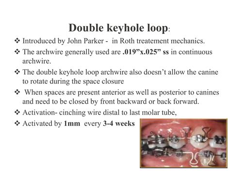 double key loop orthodontics