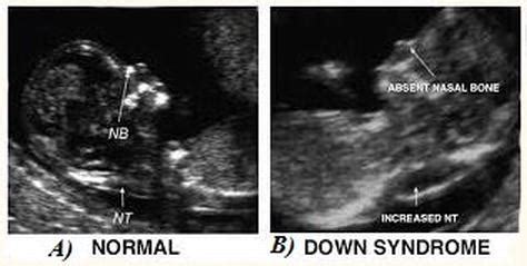 down syndrome when is it detected