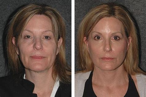 Dr. Paul Nassif reveals Facelift Results by Dr. Andrew Jacono