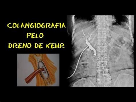 Dreno De Kehr