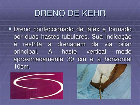 Drenos De Kehr
