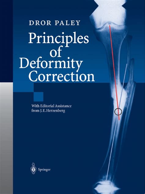 Dror Paley Principles Of Deformity Correction