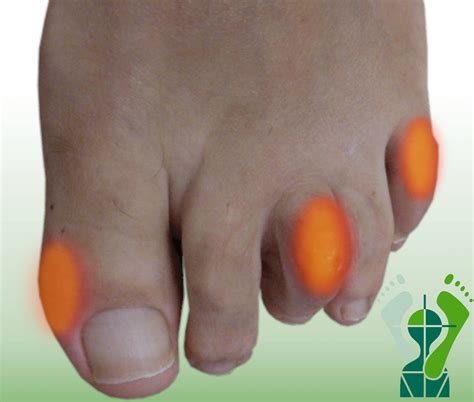 drukplekken voorkomen