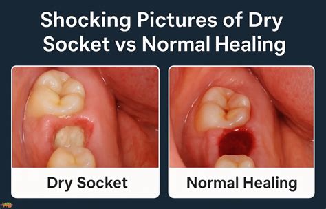 Dry Socket Vs Normal Healing Pictures