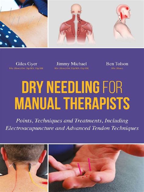 Read Online Dry Needling For Manual Therapists Points Techniques And Treatments Including Electroacupuncture And Advanced Tendon Techniques 