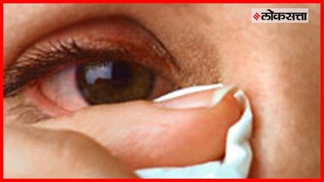dust particles in eye how to remove