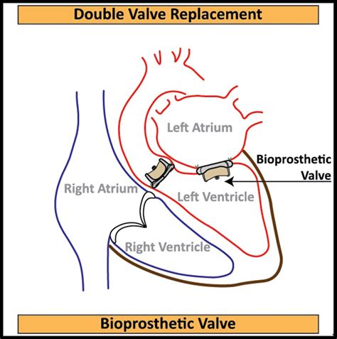 Dvr Surgery Procedure